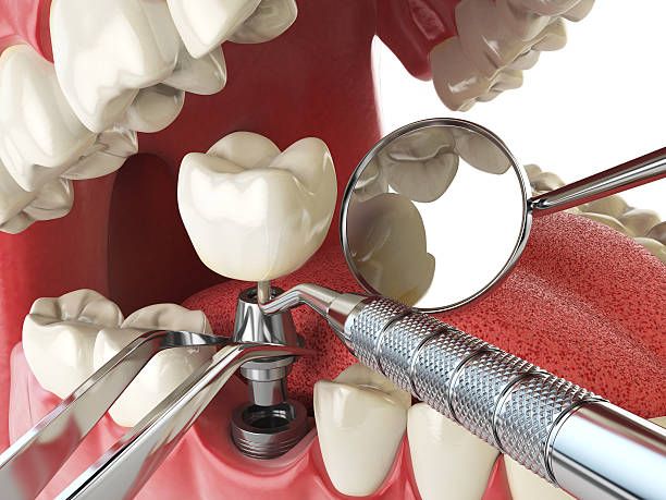 Best Emergency Root Canal Treatment in Elmwood Park, IL